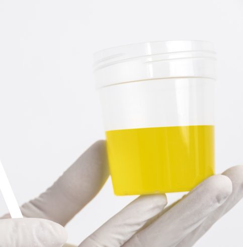 آزمایش ادرار + تفسیر – آزمایشگاه سلامت