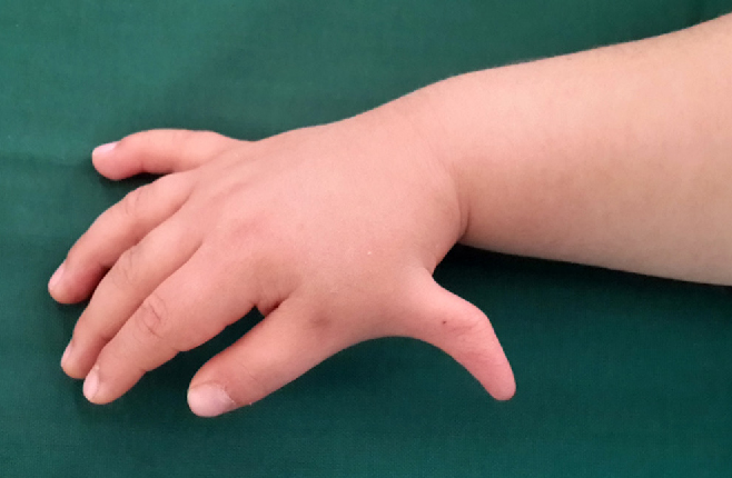 کمخونی فانکونی (Fanconi Anaemia)